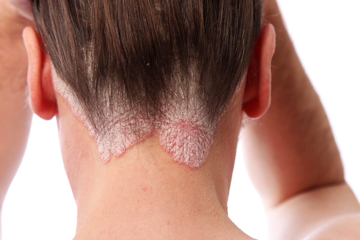 psoriasi-1-1200x800.jpg